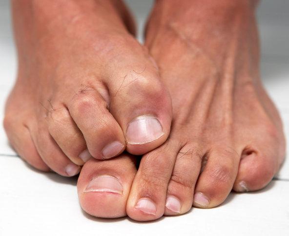 En usunn sopp på føttene på føttene: behandling med folkemidlene